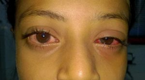 إحمرار العيون عند الأطفال: أسباب وعلاجات | مركز البراق لطب وجراحة العيون